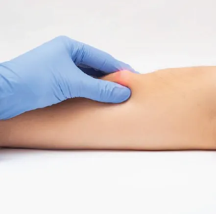 stiching-less-sebaceous-cyst-removal-page-9.webp.bv