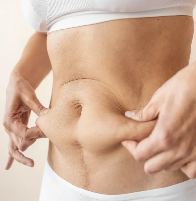 tummy-tuck-abdominoplasty-page7.webp.bv
